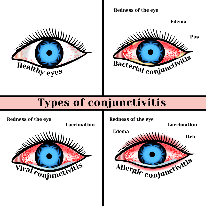 eye bacterial infection
