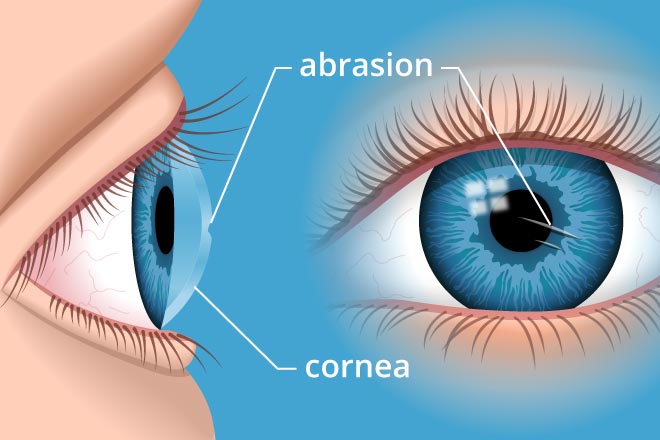 Corneal Abrasion | Associates Eye Care